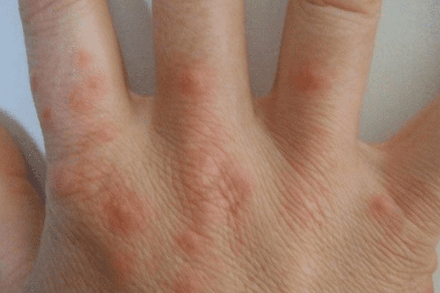 bed bugs bite hand